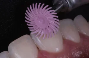 Curso de Facetas em Resina Composta