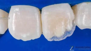 Curso de Facetas em Resina Composta