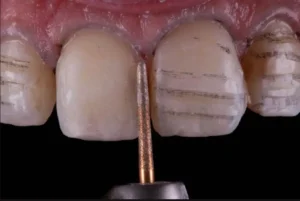 Curso de Facetas em Resina Composta