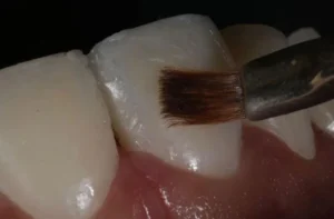 Curso de Facetas em Resina Composta