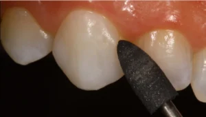 Curso Laminados Cerâmicos Acabamento - Curso de Lentes de Contato Dental