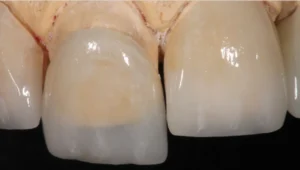 Curso Laminados Cerâmicos Peça Pronta - Curso de Lentes de Contato Dental