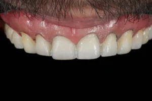 Curso Laminados Cerâmicos Preparo - Curso de Lentes de Contato Dental