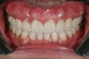 Curso Laminados Cerâmicos Provisório - Curso de Lentes de Contato Dental